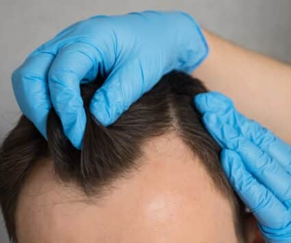 Avantages et inconvénients de la microgreffe FUE | Centre de Greffe de cheveux